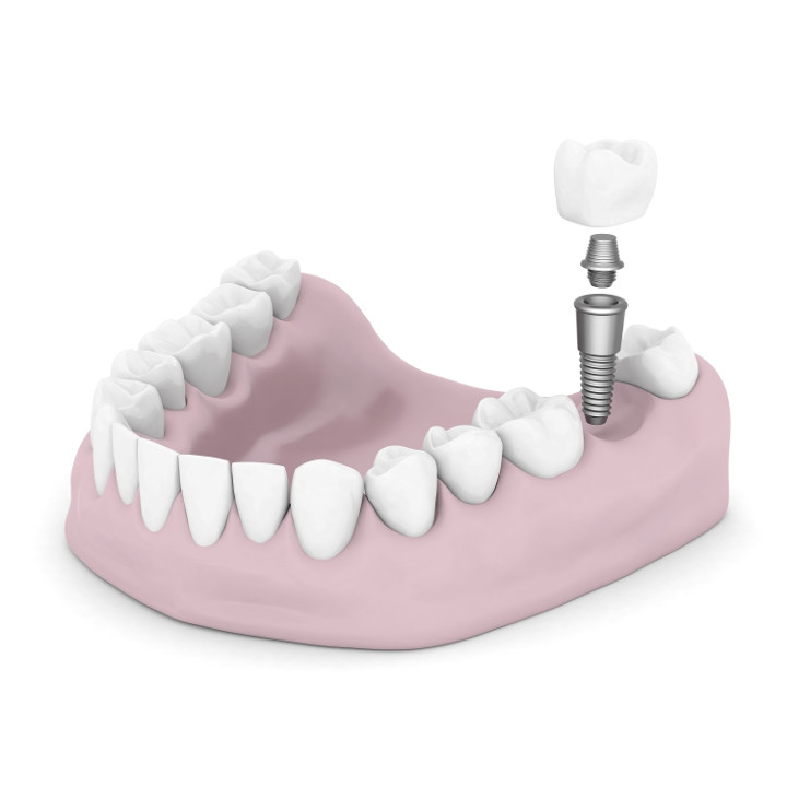 Dental Implant