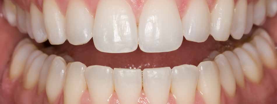 Teeth Whitening - After