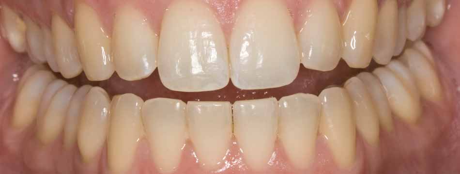 Teeth Whitening - Before